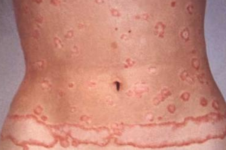 Új módszerrel kezelnék a pikkelysömört