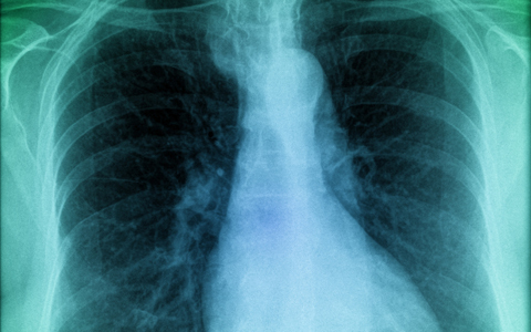 Kísérleti eljárás támaszthatja fel a tüdőt